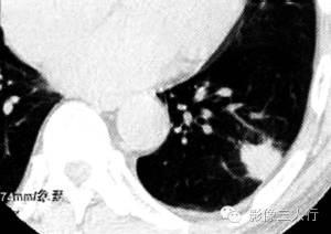 【病例】肺炎性肌纤维母细胞瘤1例CT影像表现