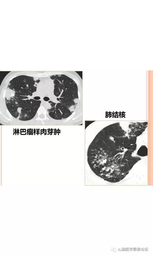 【病例】肺淋巴瘤样肉芽肿LYG一例CT影像诊断与鉴别