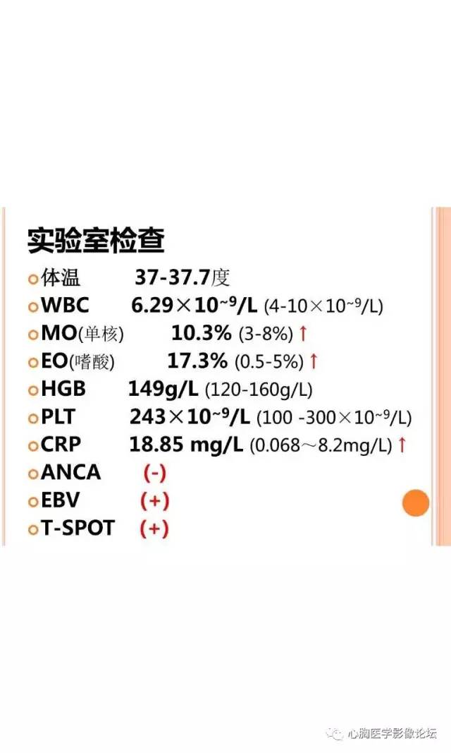 【病例】肺淋巴瘤样肉芽肿LYG一例CT影像诊断与鉴别