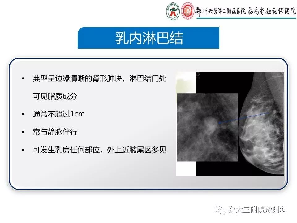 【PPT】乳腺X线特殊征象与合并征象 【PPT】乳腺X线特殊征象与合并征象