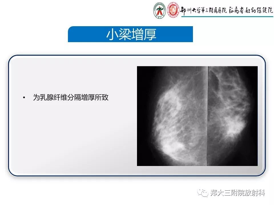 【PPT】乳腺X线特殊征象与合并征象 【PPT】乳腺X线特殊征象与合并征象