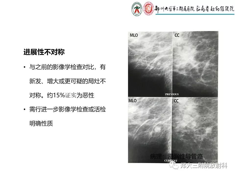 【PPT】乳腺X线特殊征象与合并征象 【PPT】乳腺X线特殊征象与合并征象