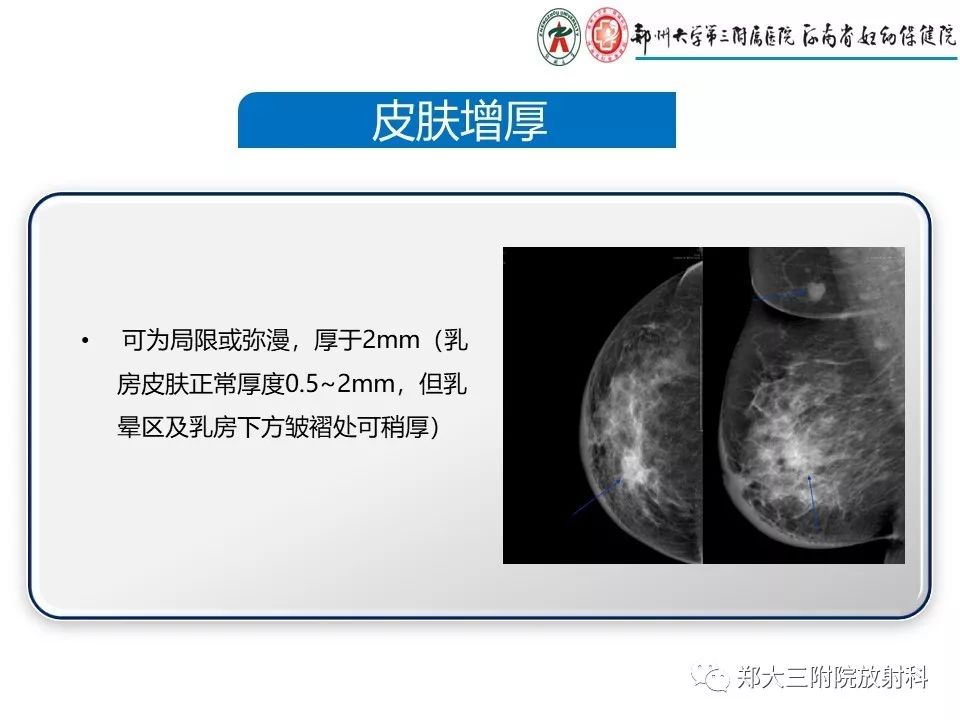 【PPT】乳腺X线特殊征象与合并征象 【PPT】乳腺X线特殊征象与合并征象