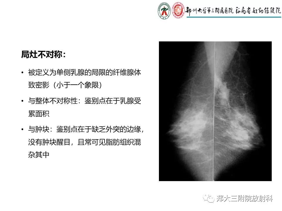 【PPT】乳腺X线特殊征象与合并征象 【PPT】乳腺X线特殊征象与合并征象