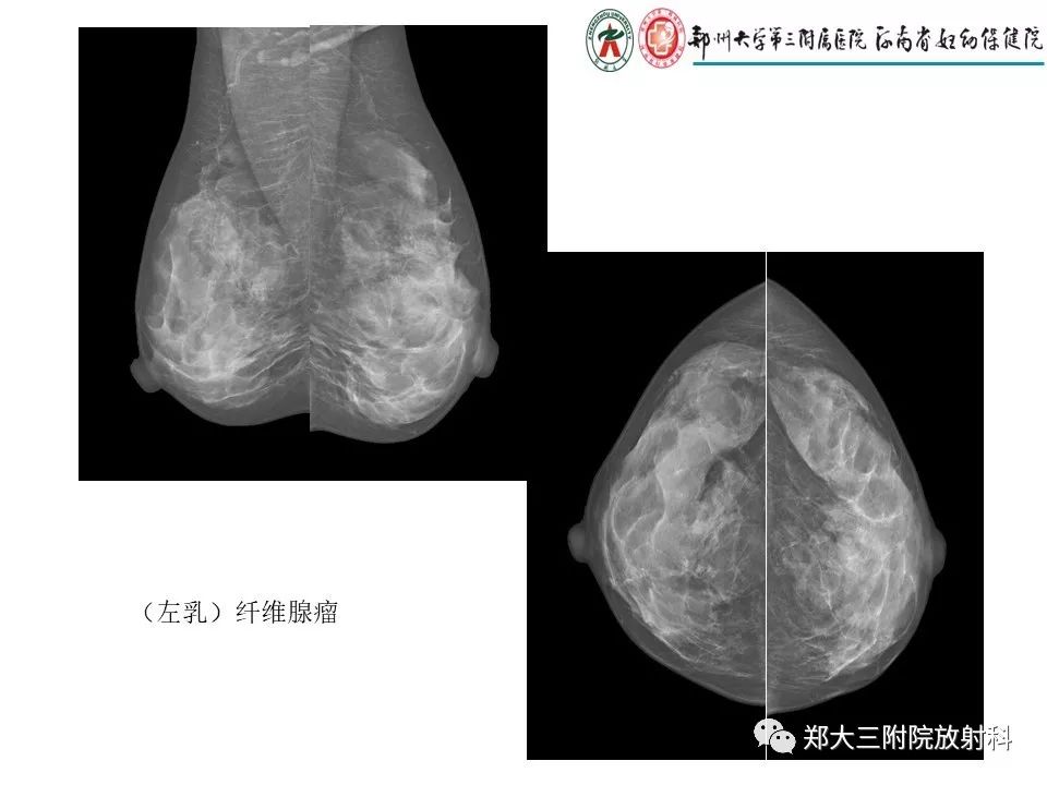 【PPT】乳腺X线特殊征象与合并征象 【PPT】乳腺X线特殊征象与合并征象