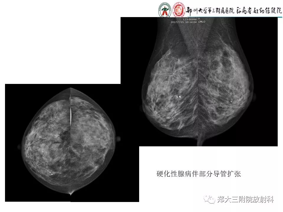 【PPT】乳腺X线特殊征象与合并征象 【PPT】乳腺X线特殊征象与合并征象
