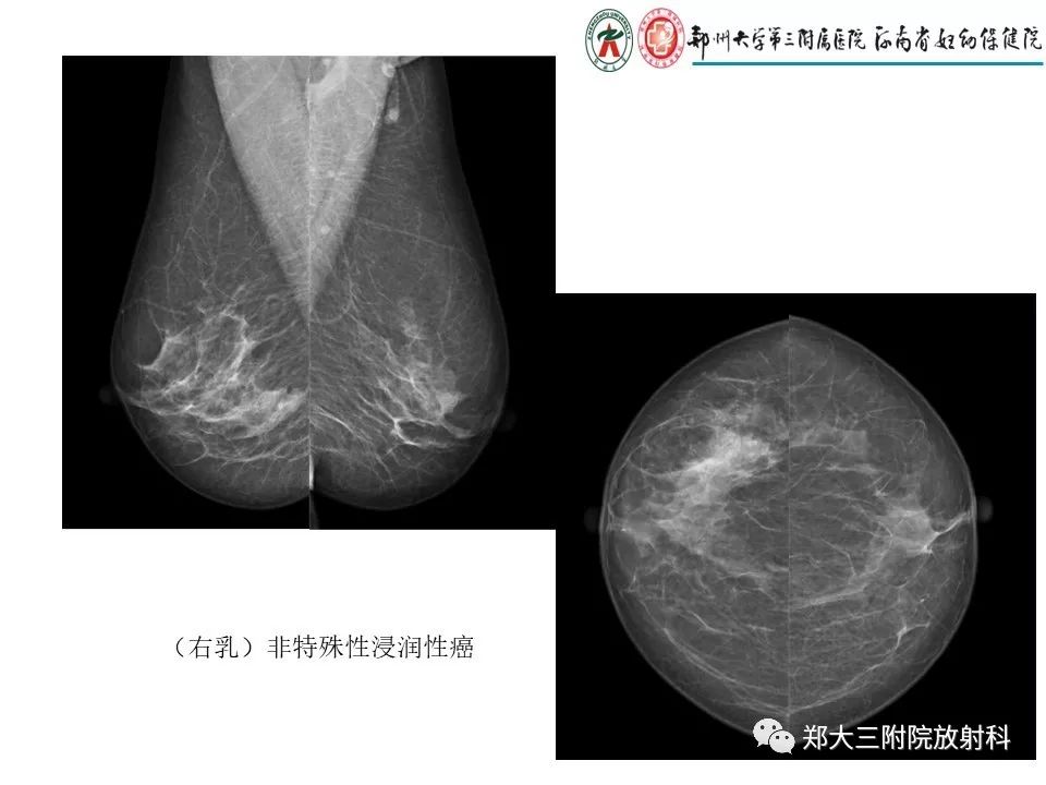 【PPT】乳腺X线特殊征象与合并征象 【PPT】乳腺X线特殊征象与合并征象