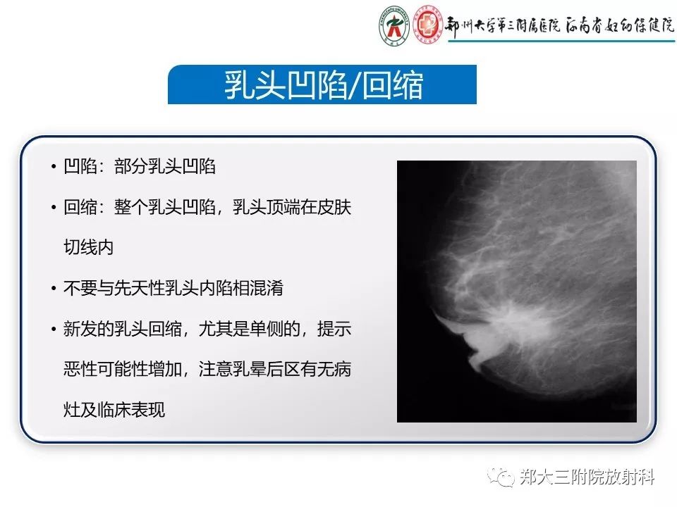 【PPT】乳腺X线特殊征象与合并征象 【PPT】乳腺X线特殊征象与合并征象