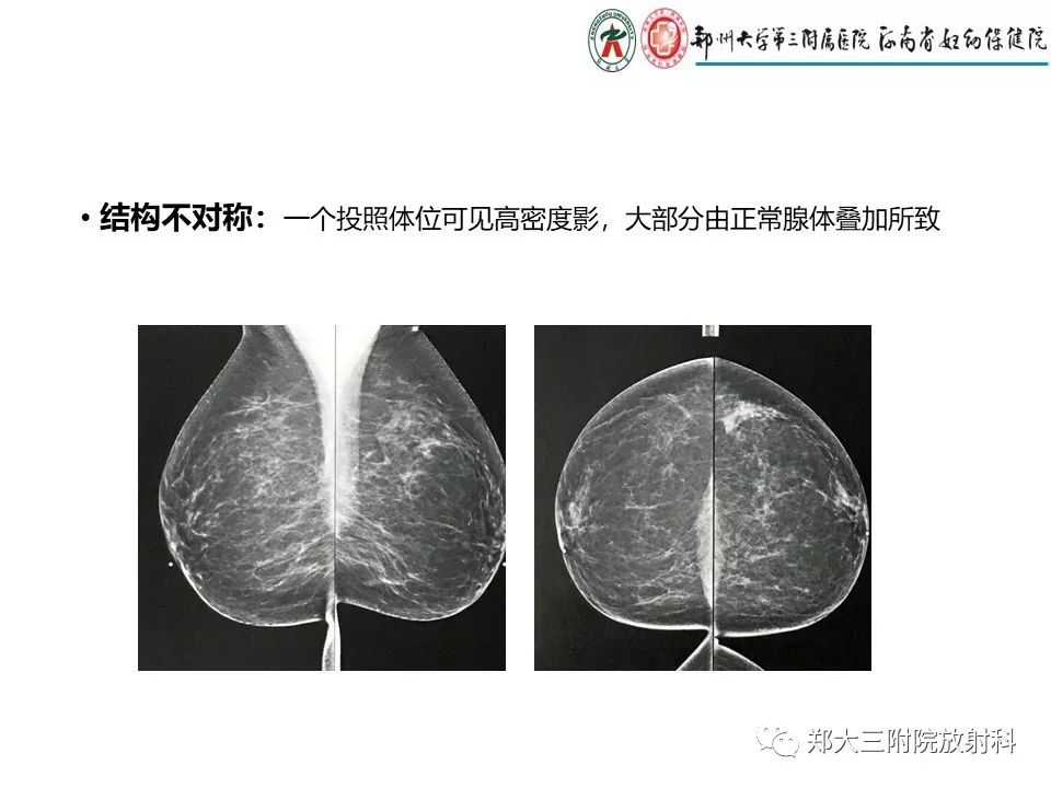 【PPT】乳腺X线特殊征象与合并征象 【PPT】乳腺X线特殊征象与合并征象