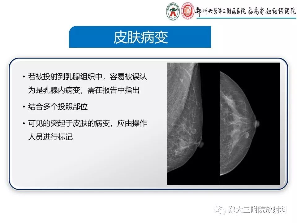 【PPT】乳腺X线特殊征象与合并征象 【PPT】乳腺X线特殊征象与合并征象