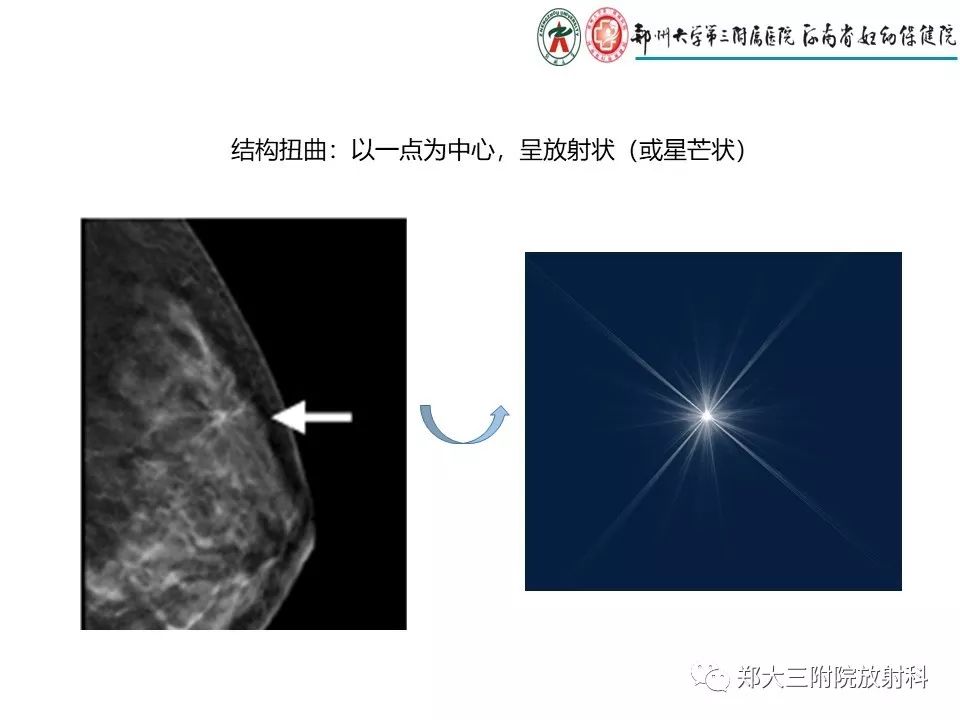 【PPT】乳腺X线特殊征象与合并征象 【PPT】乳腺X线特殊征象与合并征象