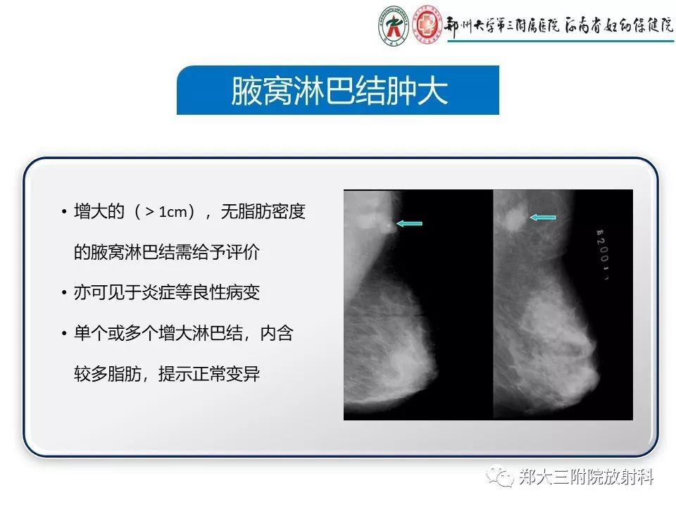 【PPT】乳腺X线特殊征象与合并征象 【PPT】乳腺X线特殊征象与合并征象