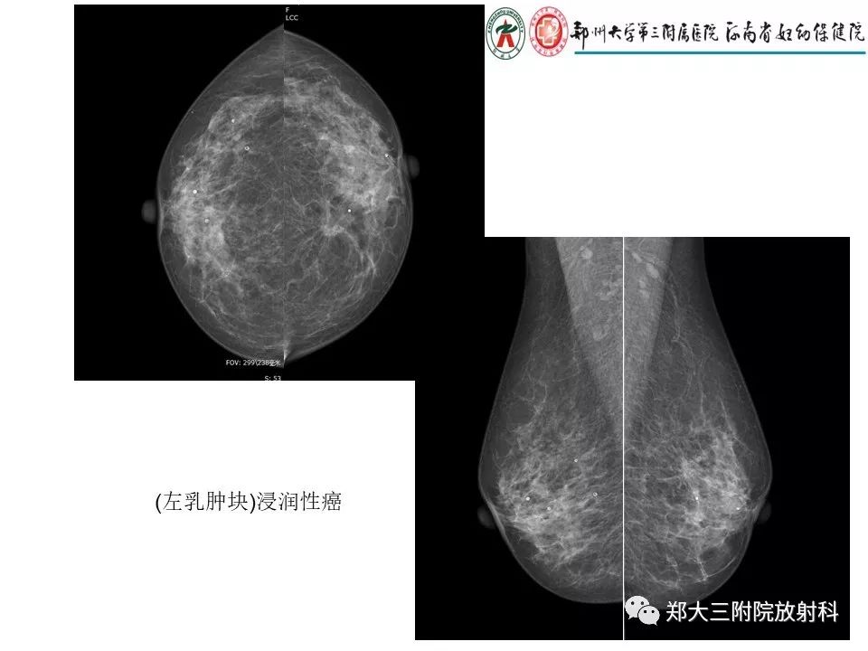 【PPT】乳腺X线特殊征象与合并征象 【PPT】乳腺X线特殊征象与合并征象
