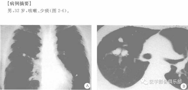 【病例】支气管闭锁1例CT