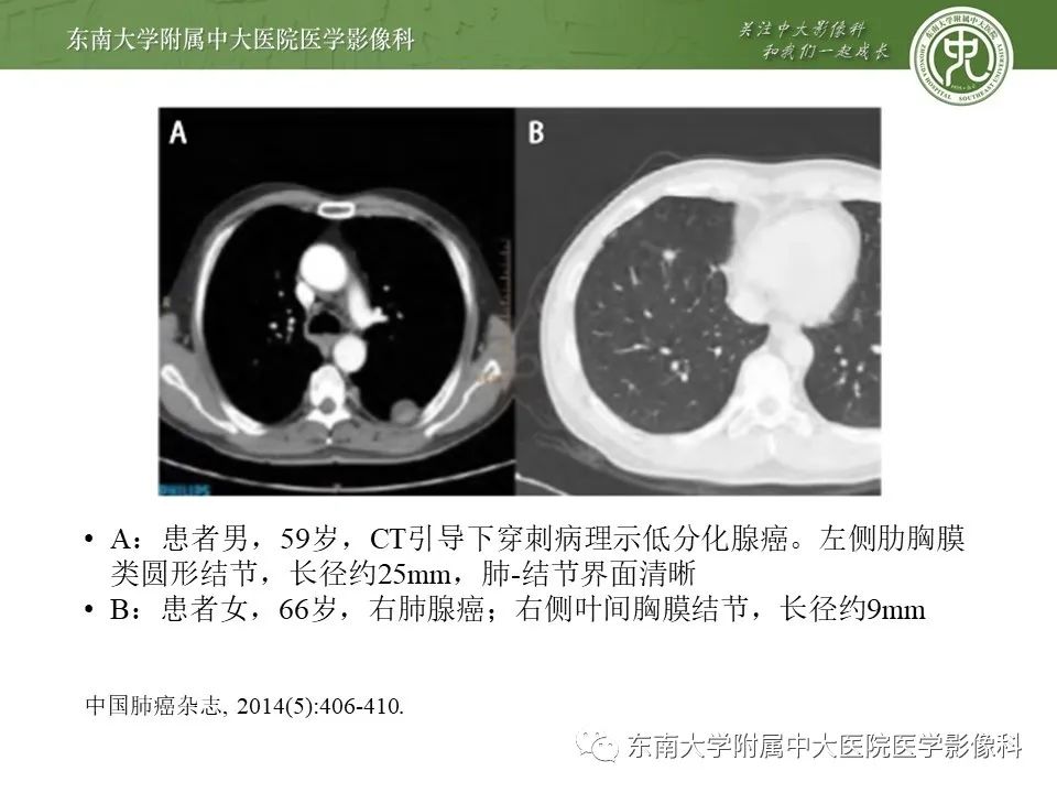【PPT】干性胸膜转移