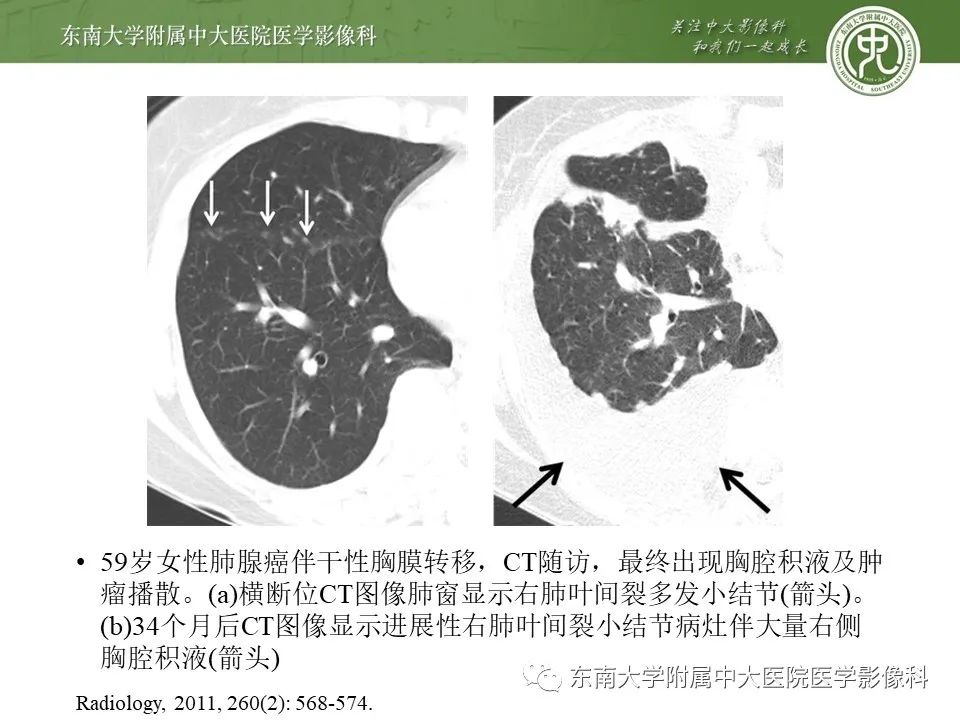 【PPT】干性胸膜转移