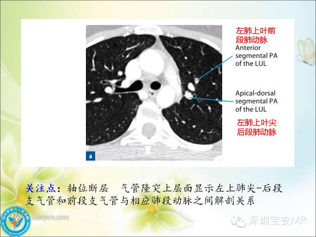【PPT】肺动、静脉影像断层解剖图解