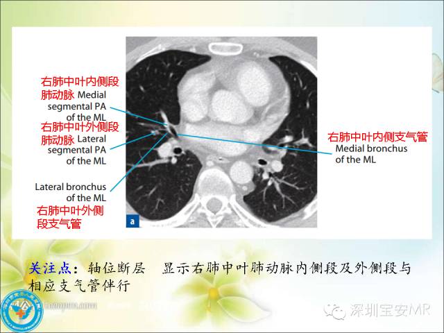 【PPT】肺动、静脉影像断层解剖图解