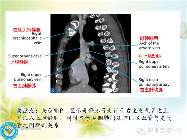 【PPT】肺动、静脉影像断层解剖图解