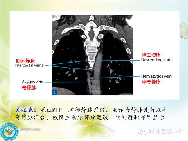 【PPT】肺动、静脉影像断层解剖图解