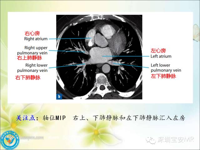 【PPT】肺动、静脉影像断层解剖图解