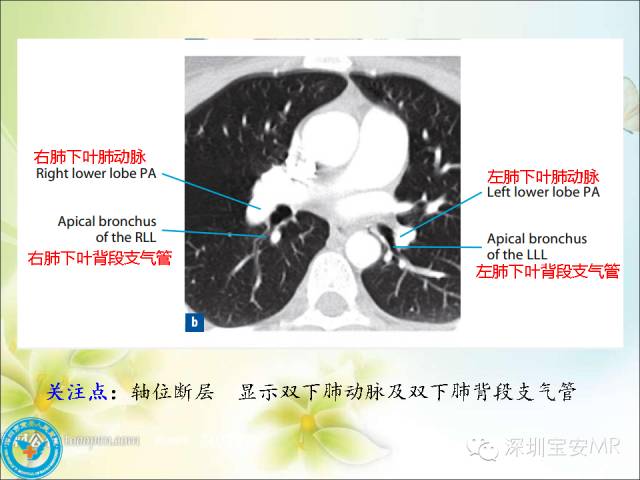 【PPT】肺动、静脉影像断层解剖图解
