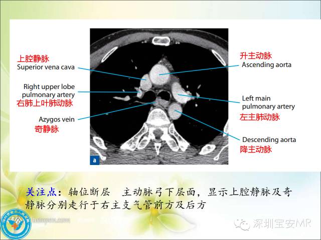 【PPT】肺动、静脉影像断层解剖图解
