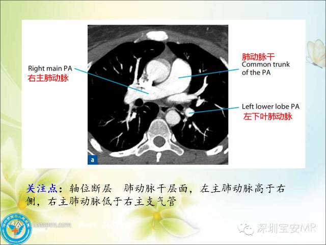 【PPT】肺动、静脉影像断层解剖图解