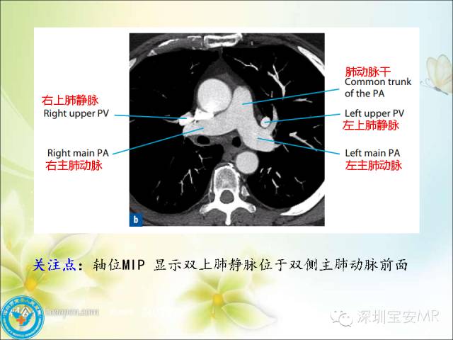 【PPT】肺动、静脉影像断层解剖图解