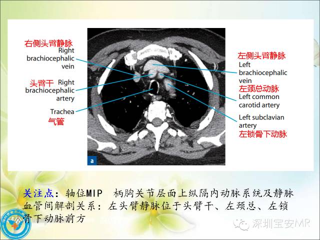 【PPT】肺动、静脉影像断层解剖图解