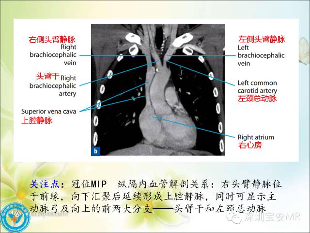【PPT】肺动、静脉影像断层解剖图解