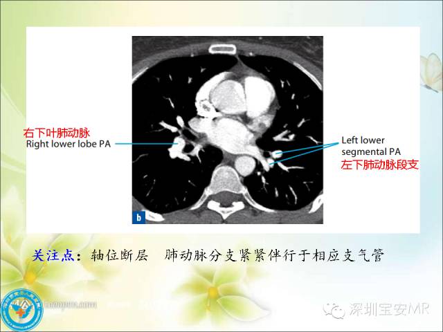 【PPT】肺动、静脉影像断层解剖图解