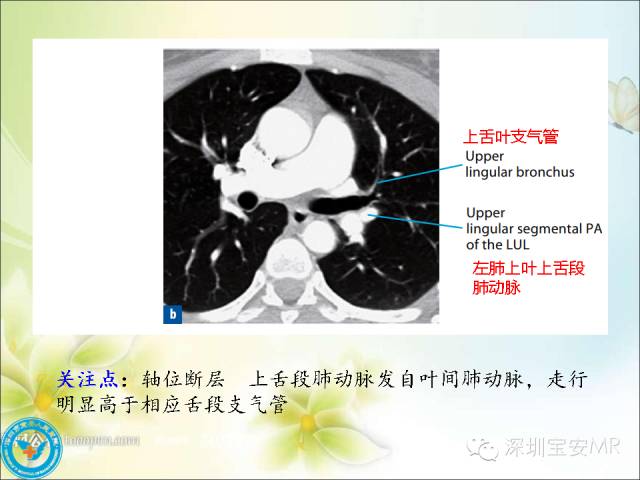 【PPT】肺动、静脉影像断层解剖图解