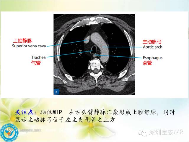 【PPT】肺动、静脉影像断层解剖图解