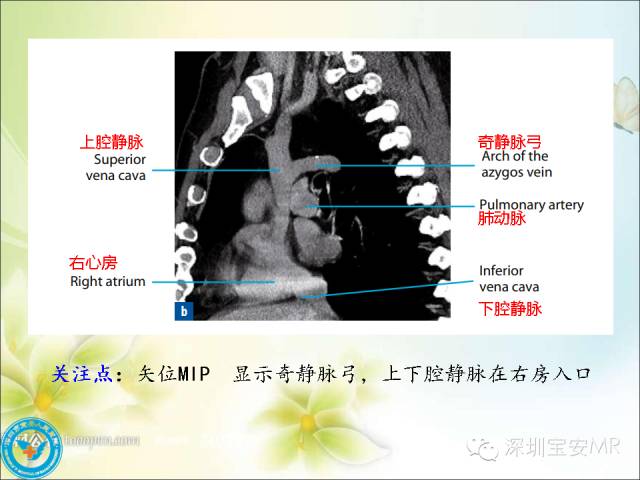 【PPT】肺动、静脉影像断层解剖图解