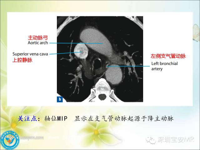 【PPT】肺动、静脉影像断层解剖图解
