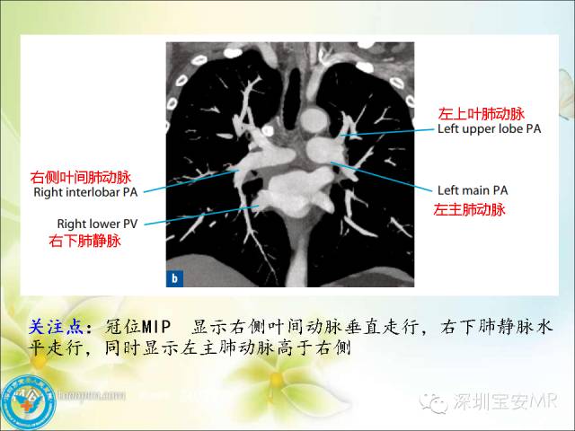 【PPT】肺动、静脉影像断层解剖图解