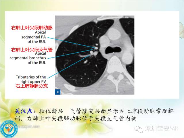 【PPT】肺动、静脉影像断层解剖图解