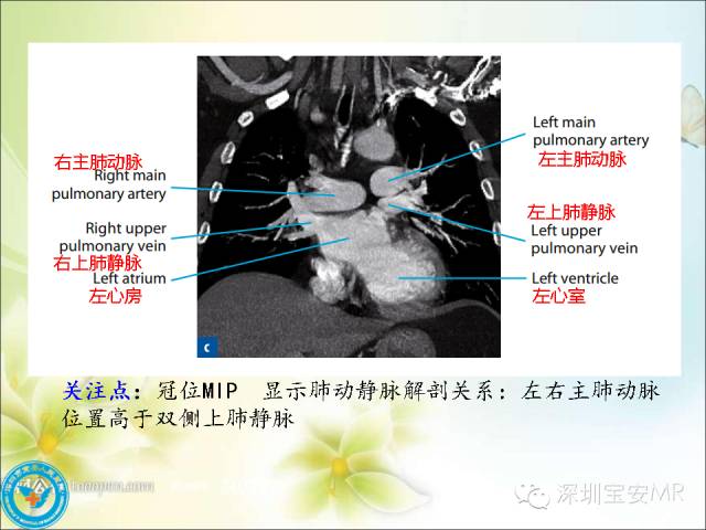 【PPT】肺动、静脉影像断层解剖图解