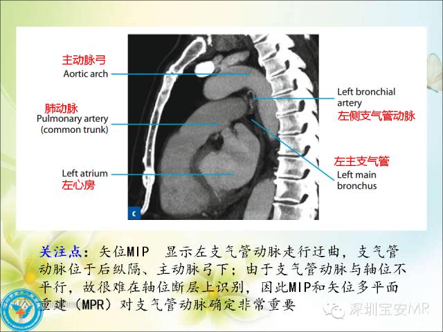 【PPT】肺动、静脉影像断层解剖图解