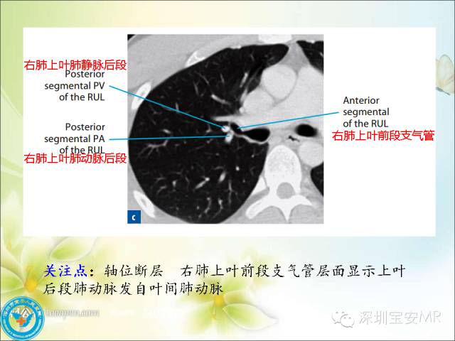 【PPT】肺动、静脉影像断层解剖图解