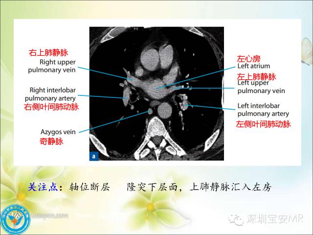 【PPT】肺动、静脉影像断层解剖图解