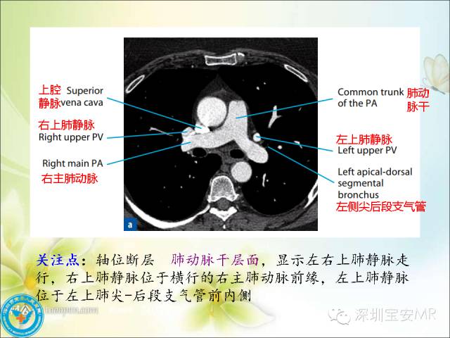 【PPT】肺动、静脉影像断层解剖图解