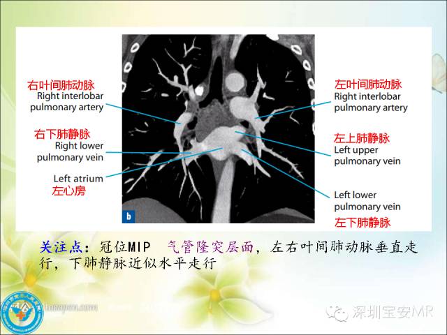 【PPT】肺动、静脉影像断层解剖图解