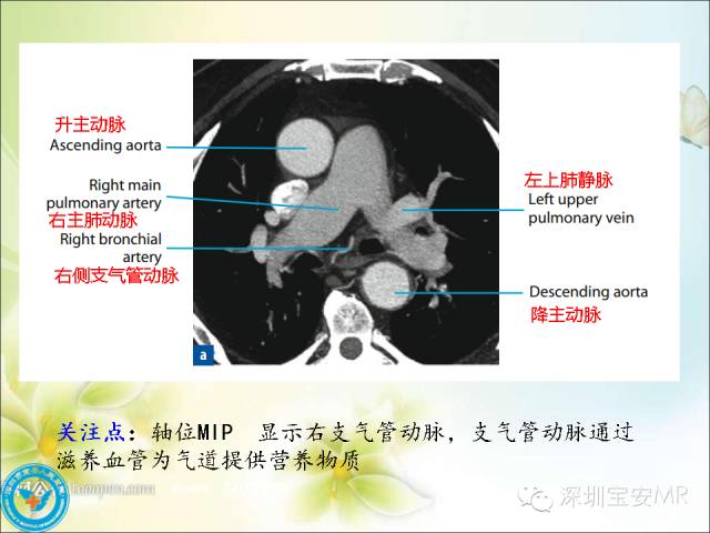 【PPT】肺动、静脉影像断层解剖图解