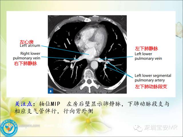 【PPT】肺动、静脉影像断层解剖图解