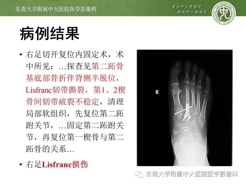 【PPT】Lisfranc损伤