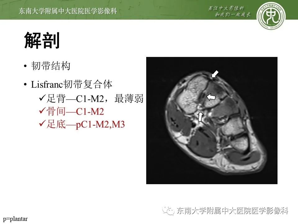 【PPT】Lisfranc损伤