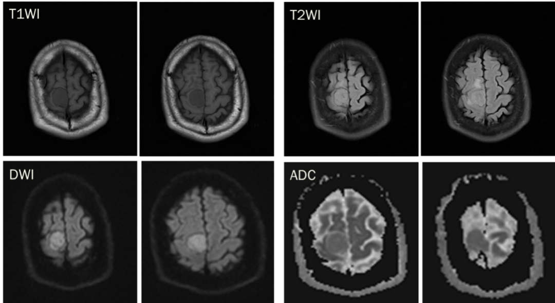 脑膜瘤与血管外皮瘤的 MRI 诊断与鉴别诊断