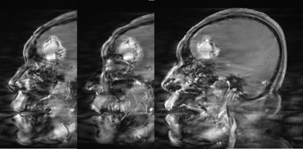 脑膜瘤与血管外皮瘤的 MRI 诊断与鉴别诊断 脑膜瘤与血管外皮瘤的 MRI 诊断与鉴别诊断